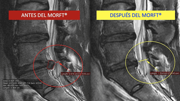 Antes y después del MORFT
